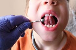 Nhiều bác sĩ Mỹ chỉ định cắt thắng lưỡi trẻ sơ sinh bừa bãi